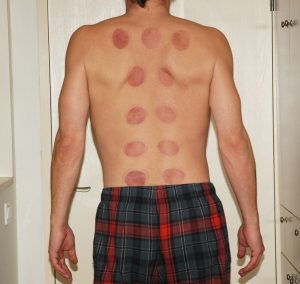 acupuncture-cupping-therapy