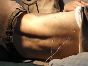 acupuncture needles